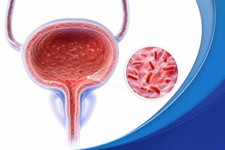 Ilustração de um trato urinário feminino com bactérias em formato de pontos vermelhos.