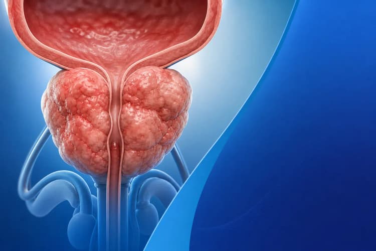 Ilustração médica mostrando a glândula prostática aumentada com contornos irregulares e lobulados.